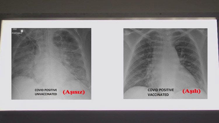 aşı-röntgen